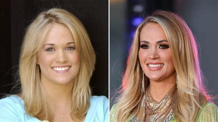 Carrie Underwood's Plastic Surgery Transformation Revealed