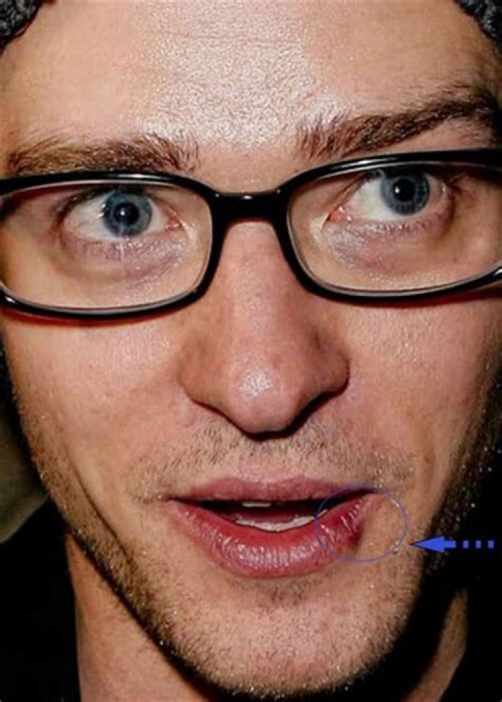 Celebrities with Cold Sores: Understanding the Stigma and Reality