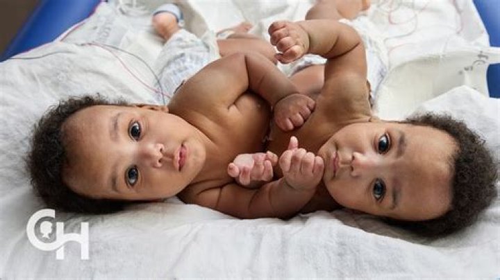Conjoined Twins in Dayton Ohio: A Comprehensive Exploration of Their Lives and Impact
